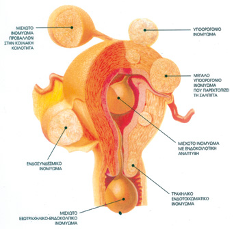 Ινομυώματα μήτρας